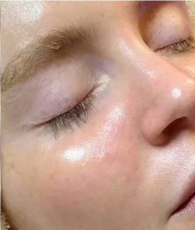 Après - Peau purifiée et hydratée